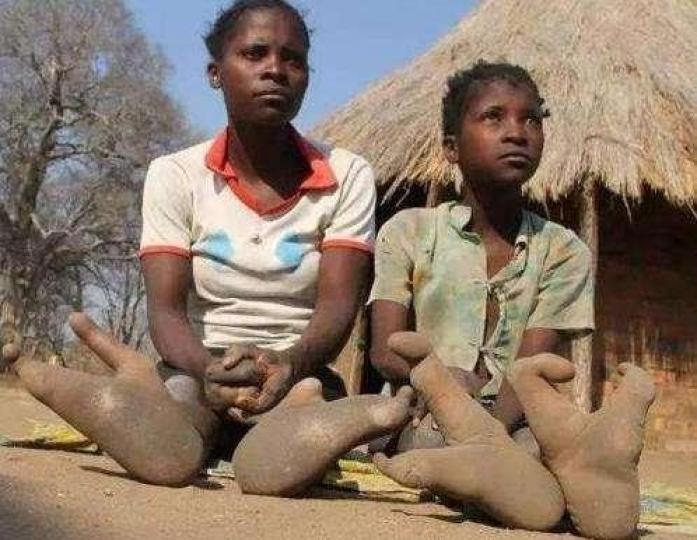 在非洲有個神秘部落瓦
多瑪,那里有些族人脚
上天生衹有兩隻脚趾
但並不影響日常工作
和生活,爬樹要比正常
人還要快捷...