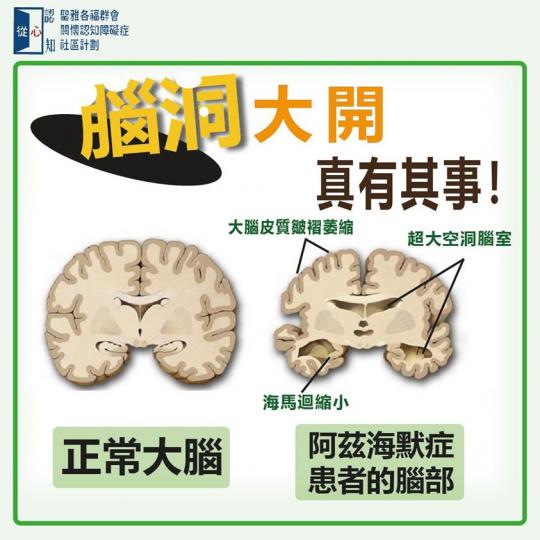 「腦洞大開」是網絡用語,形容人有超凡想像力;但也確切描述了患上阿茲海默症 (即認知障礙症的其中一種)人士的腦部情況。
阿茲海默症指患者的腦部積聚「澱粉狀蛋白斑塊」(amyloid) ,引致腦細胞逐漸死... 「腦洞大開」是網絡用語,形容人有超凡想像力;但也確切描述了患上阿茲海默症 (即認知障礙症的其中一種)人士的腦部情況。
阿茲海默症指患者的腦部積聚「澱粉狀蛋白斑塊」(amyloid) ,引致腦細胞逐漸死...