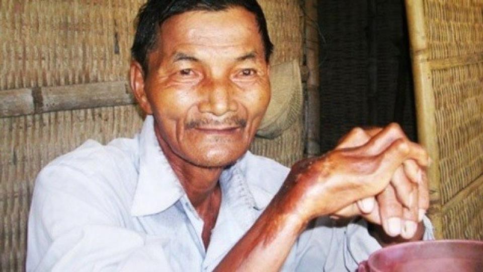 據説這名越南農民50年
前發病高燒之後,就再
也無法真正睡眠,就算
食安眠藥,或被灌醉，
等等方法也無法睡覺
但身體基本沒有問題...