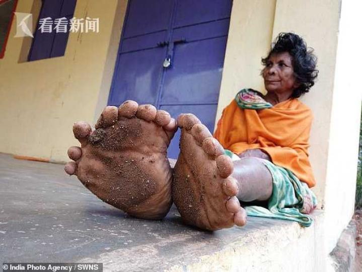 印度一名60多歲女子的
雙脚有19隻脚趾,雙手
有12根手指,創下世界
紀錄...