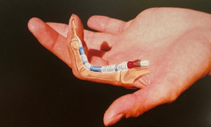扳機指
扳機指俗稱「彈弓指」，一般患者多接受物理治療。從中醫角度，扳機指是風濕或類風濕性關節炎的早期表現或因勞損而引致，中醫治療會從誘因入手。...