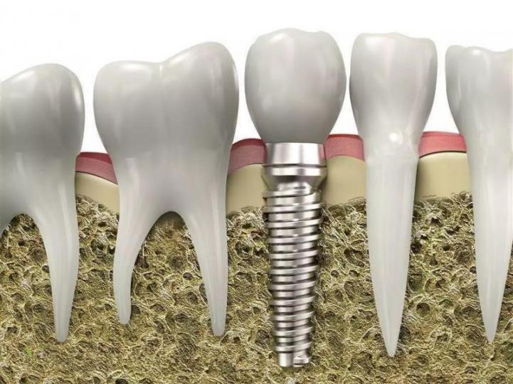 種牙
種牙是把鈦金屬植入牙槽骨內，以填補失去的牙齒。 此治療會較採用鑲 配活動假牙或牙橋舒適。 牙科醫生會根據顎骨的情況，而決定嵌入植體 的類型及程序。...