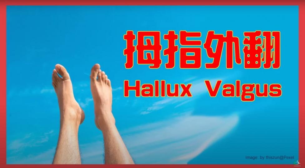 腳痛之拇指外翻Hallux Valgus【傷患痛症系列】