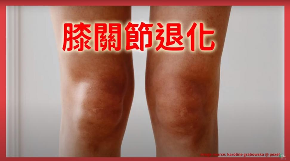 膝痛之膝關節退化 Knee Osteoarthritis【傷患痛症系列】