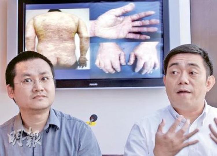 牛皮癬患者黎先生（左）和傅先生（右）表示，用生物製劑後病况明顯改善。黎先生指藥物昂貴，不得不停用。（李紹昌攝）