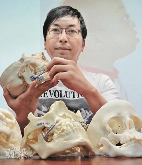 手持自己口腔模型的李先生，下顎粉碎後曾在牙骱嵌入鐵片，事後出現睡眠窒息，「牽引成骨術」成功把他下顎向前移動數十毫米，外表上分別不大，但睡眠質素卻有天淵之別。（曾愛盈攝）「牽引成骨手術」會在病人下顎的牙骱位置植入牽引器，病人每天自行把支架左右的轉盤轉兩圈，便可把下顎骨向推前1毫米，待3個月後骨骼定形後，便可動手術把牽引器取出。（曾愛盈攝）