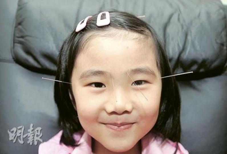 4歲的希希接受針灸治療弱視。她發現針灸原來不痛,現已不再害怕,乖乖讓中醫師在她的面上扎針。(朱永倫攝) 4歲的希希接受針灸治療弱視。她發現針灸原來不痛,現已不再害怕,乖乖讓中醫師在她的面上扎針。(朱永倫攝)