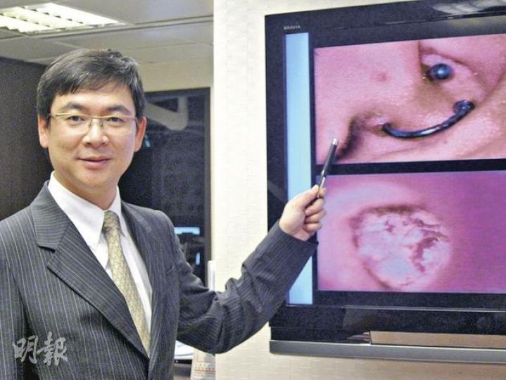 耳鼻喉科專科醫生黃漢威表示,在耳朵的軟骨上穿耳出現嚴重發炎的風險,較在耳珠穿耳高出幾倍。(林小詩攝) 耳鼻喉科專科醫生黃漢威表示,在耳朵的軟骨上穿耳出現嚴重發炎的風險,較在耳珠穿耳高出幾倍。(林小詩攝)