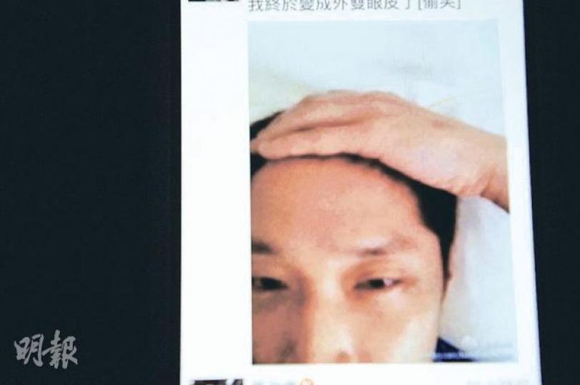馬仔左眼受傷,他拍下照片放上微博,還自嘲﹕「終於變了雙眼皮!」(微博圖片) 馬仔左眼受傷,他拍下照片放上微博,還自嘲﹕「終於變了雙眼皮!」(微博圖片)