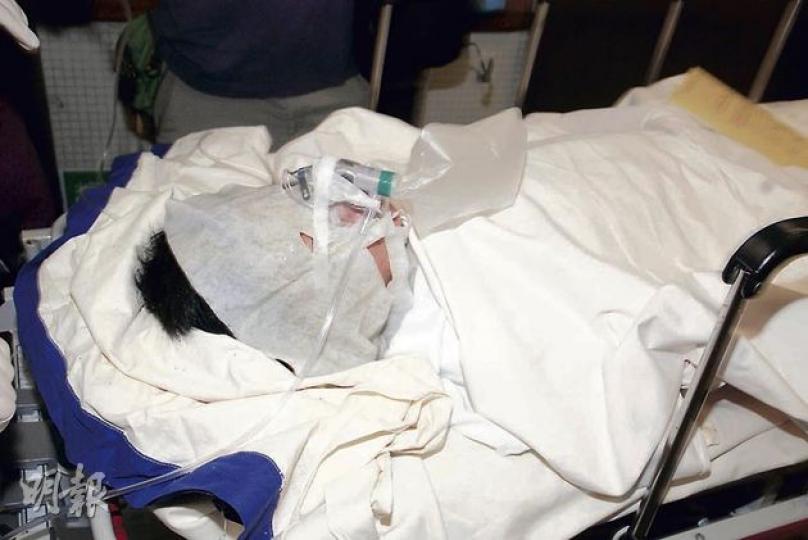 在山頂白加道寓所被香薰油灼傷的男童,送院時以臉膜敷臉。(雲錦鋒攝) 在山頂白加道寓所被香薰油灼傷的男童,送院時以臉膜敷臉。(雲錦鋒攝)
