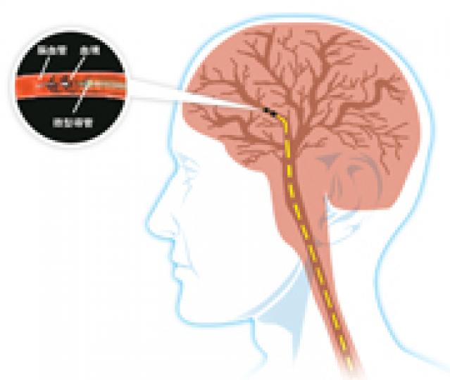 中風新療法以導管探入腦內，直接吸走血塊。（明報製圖） 神經外科專科醫生彭家雄（鄭寶華攝）