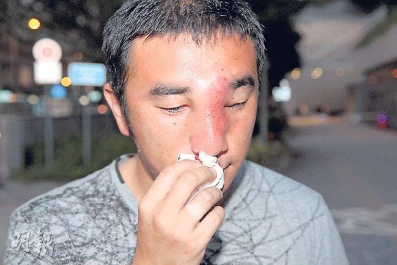 採訪時被深圳公安毆打的《南早》記者王智強，昨晚返港求醫時，鼻子仍在滲血，醫生確定他鼻骨輕微爆裂，毋須留醫。（伍浦鋒攝）