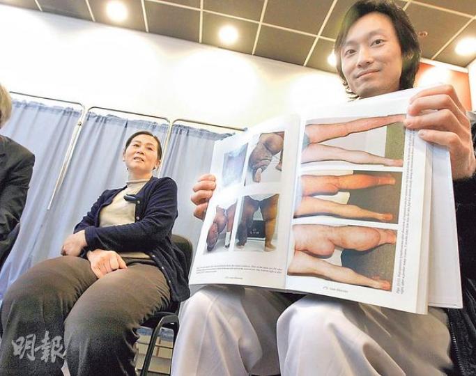 患有先天淋巴水腫的張女士(左),多年來受水腫的「象腿」困擾,甚至不能走路,最後向明愛醫院外科部資深護師鍾献滿(右)求助,鍾献滿手執照片解釋外國病例,指患者會水腫致小腿「起摺」或肌肉呈球狀。(李紹昌攝) 患有先天淋巴水腫的張女士(左),多年來受水腫的「象腿」困擾,甚至不能走路,最後向明愛醫院外科部資深護師鍾献滿(右)求助,鍾献滿手執照片解釋外國病例,指患者會水腫致小腿「起摺」或肌肉呈球狀。(李紹昌攝)