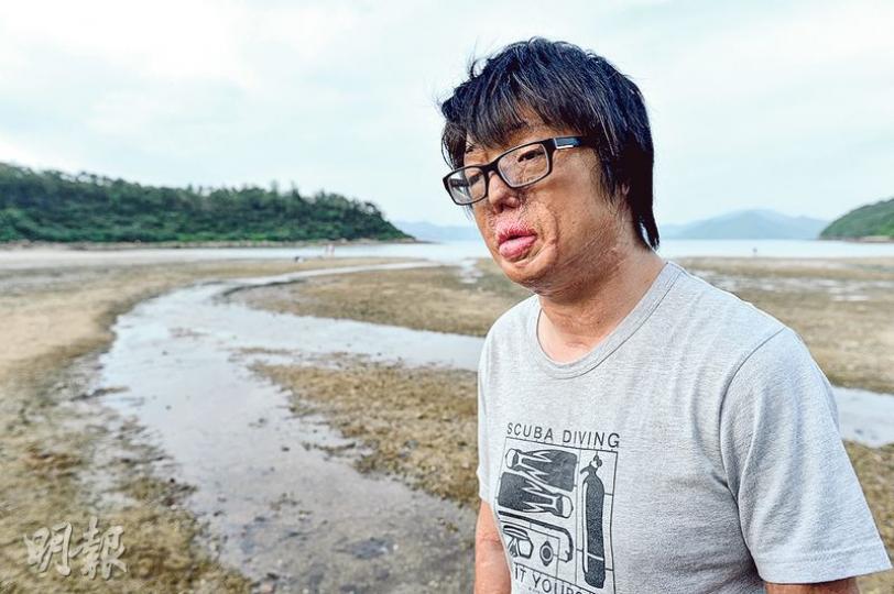 八仙嶺山火倖存者張潤衡(圖)在山火後毁容,經多年努力始走出陰霾,本想藉是次探望台灣粉塵爆炸傷者,給對方支持及鼓勵,結果在網上被批評忽略傷者和家屬感受;他對此感無奈,但稱無悔此行,相信家屬明白其動機。(鄧宗弘攝)(鄧宗弘攝) 八仙嶺山火倖存者張潤衡(圖)在山火後毁容,經多年努力始走出陰霾,本想藉是次探望台灣粉塵爆炸傷者,給對方支持及鼓勵,結果在網上被批評忽略傷者和家屬感受;他對此感無奈,但稱無悔此行,相信家屬明白其動機。(鄧宗弘攝)(鄧宗弘攝)
