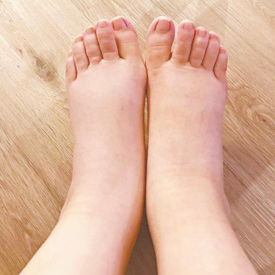 ■熊黛林腳腫如豬蹄,笑言未知何時才能穿高跟鞋。微博圖片■熊黛林日前為郭可頌誕下孖女。資料圖片 ■熊黛林腳腫如豬蹄,笑言未知何時才能穿高跟鞋。微博圖片■熊黛林日前為郭可頌誕下孖女。資料圖片