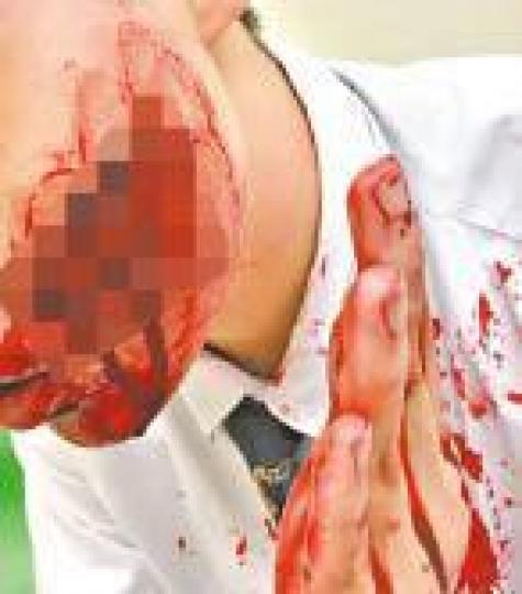 森仔遇襲後傷口血流如注,事後縫了70針。受訪者提供圖片 森仔遇襲後傷口血流如注,事後縫了70針。受訪者提供圖片