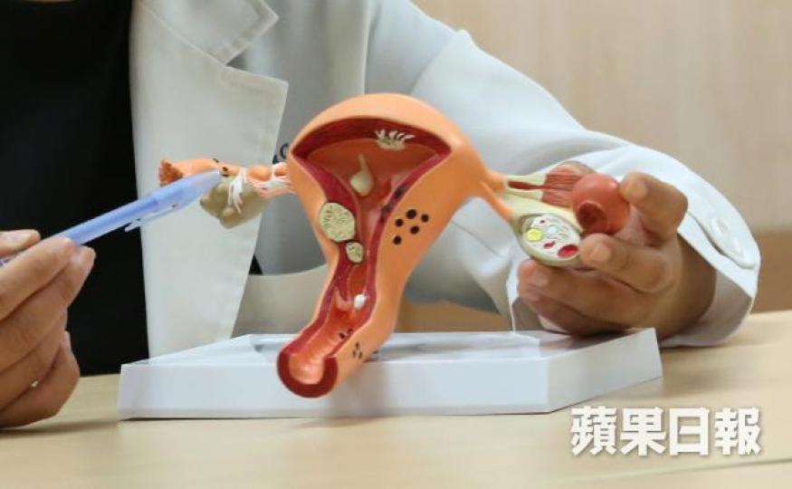 筆者指子宮內膜異位症(俗稱朱古力瘤)雖屬西醫疾病,但中醫角度類似於「癥瘕」一病。資料圖片 筆者指子宮內膜異位症(俗稱朱古力瘤)雖屬西醫疾病,但中醫角度類似於「癥瘕」一病。資料圖片