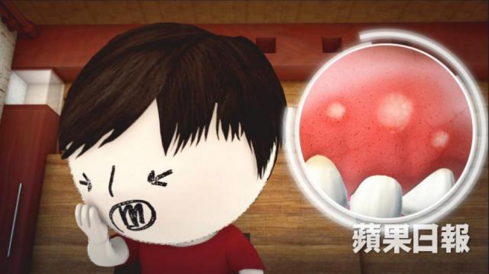 中醫稱痱滋為「口瘡」。 中醫稱痱滋為「口瘡」。