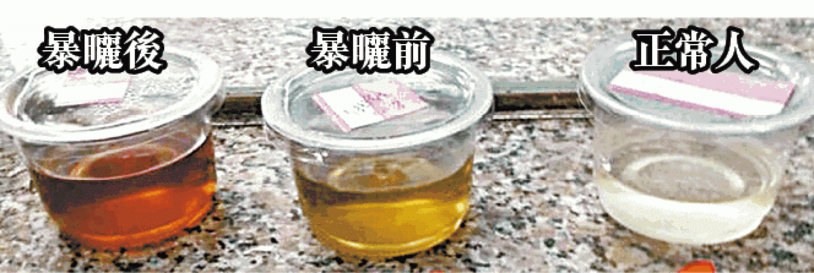 患者尿液經暴曬後轉成咖啡色。 患者尿液經暴曬後轉成咖啡色。