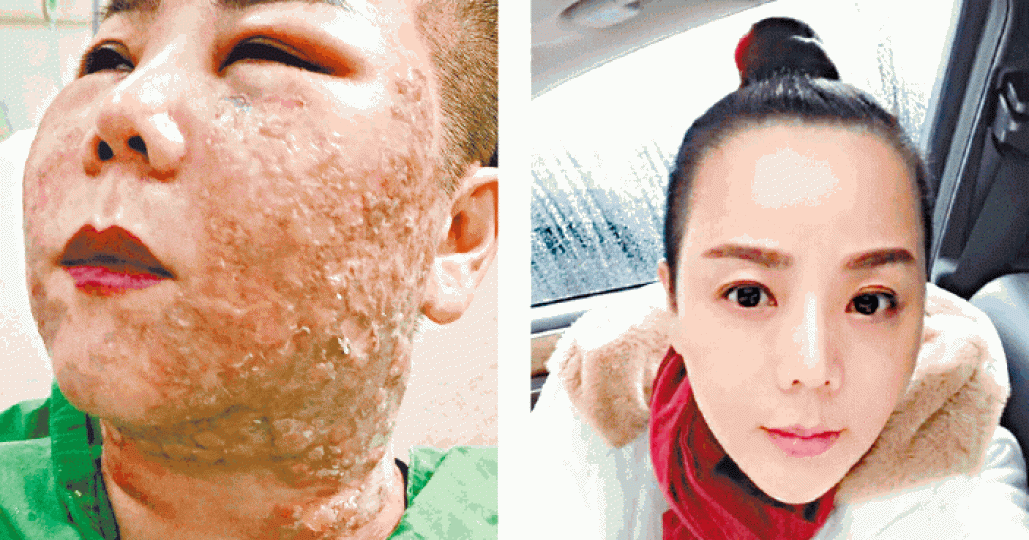 林女遭毀容前樣貌標致,整容後滿面水泡慘不忍睹。 林女遭毀容前樣貌標致,整容後滿面水泡慘不忍睹。